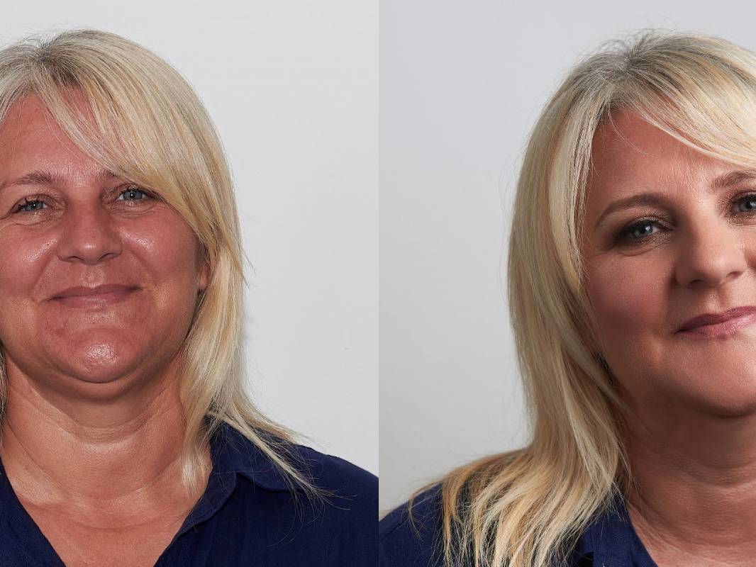 amalija prije poslije